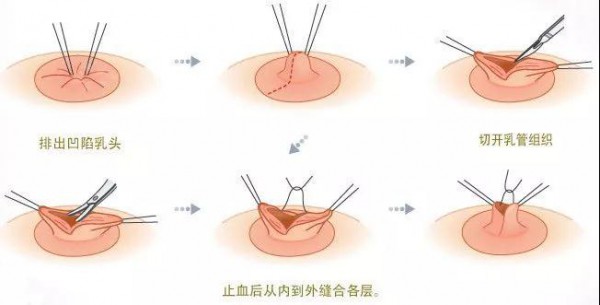 乳头凹陷是乳腺癌的表现吗?