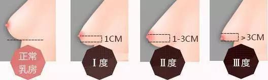 哺乳期过后胸部松弛下垂怎么办  预防胸部松弛妙招